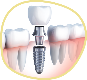 diagram of dental implant procedure secured into the jawbone