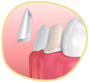 illustration of a veneer being placed on a prepped tooth