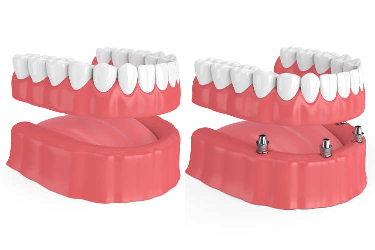 Side by side comparison photo of regular dentures and implant-supported dentures to replace teeth