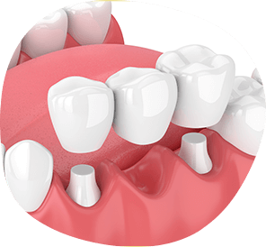 illustration of a dental bridge