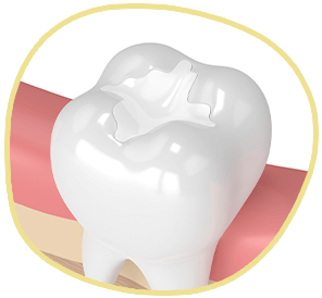 illustration of a veneer being placed on a prepped tooth