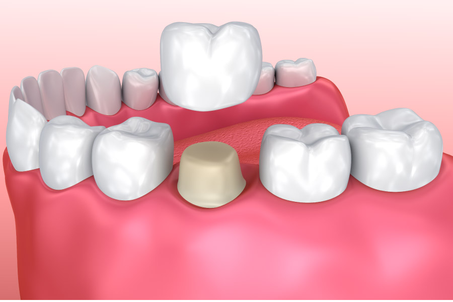 model of lower jaw with a dental crown