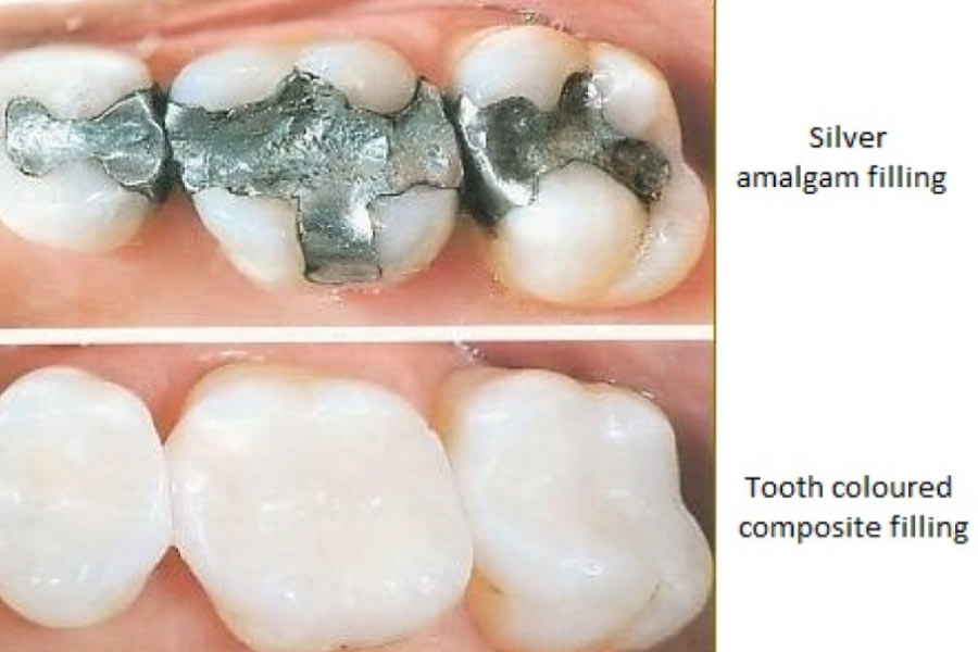 comparison between amalgam and porcelain dental fillings