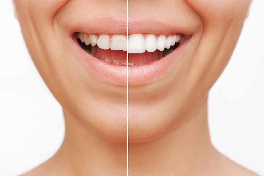 porcelain veneers before and after