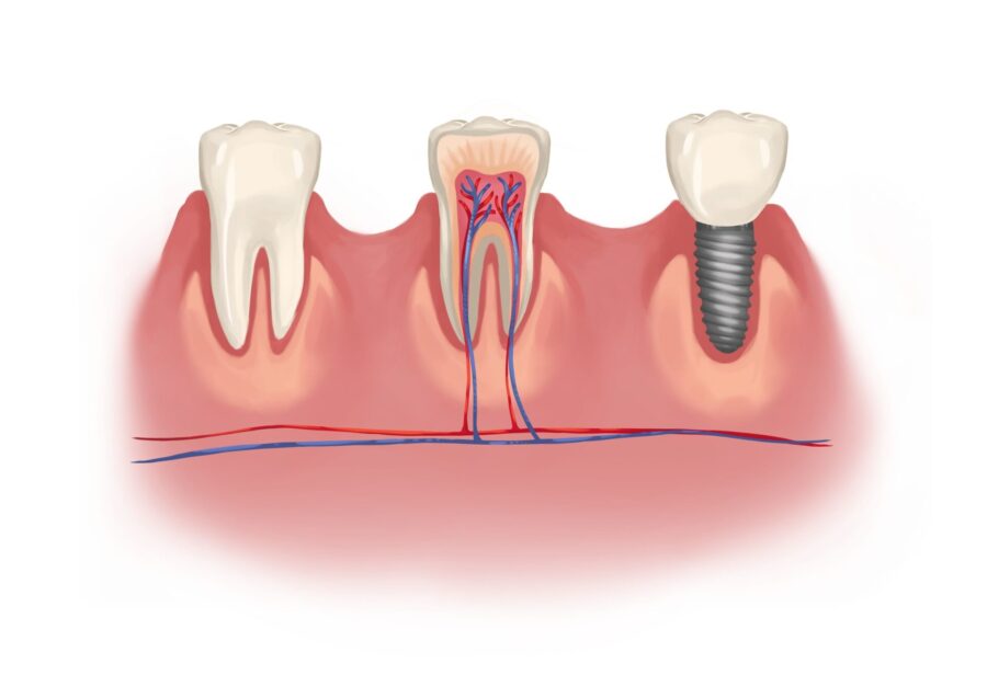 implant crown vs natural tooth, dental crown