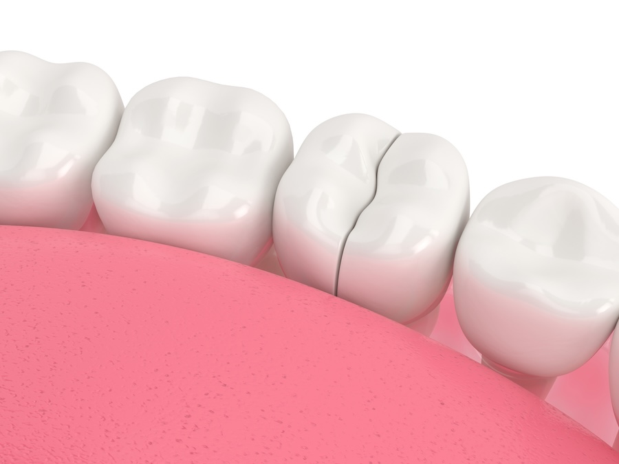 cracked dental crown